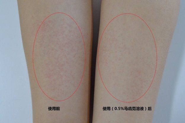 马齿苋提取物抗过敏